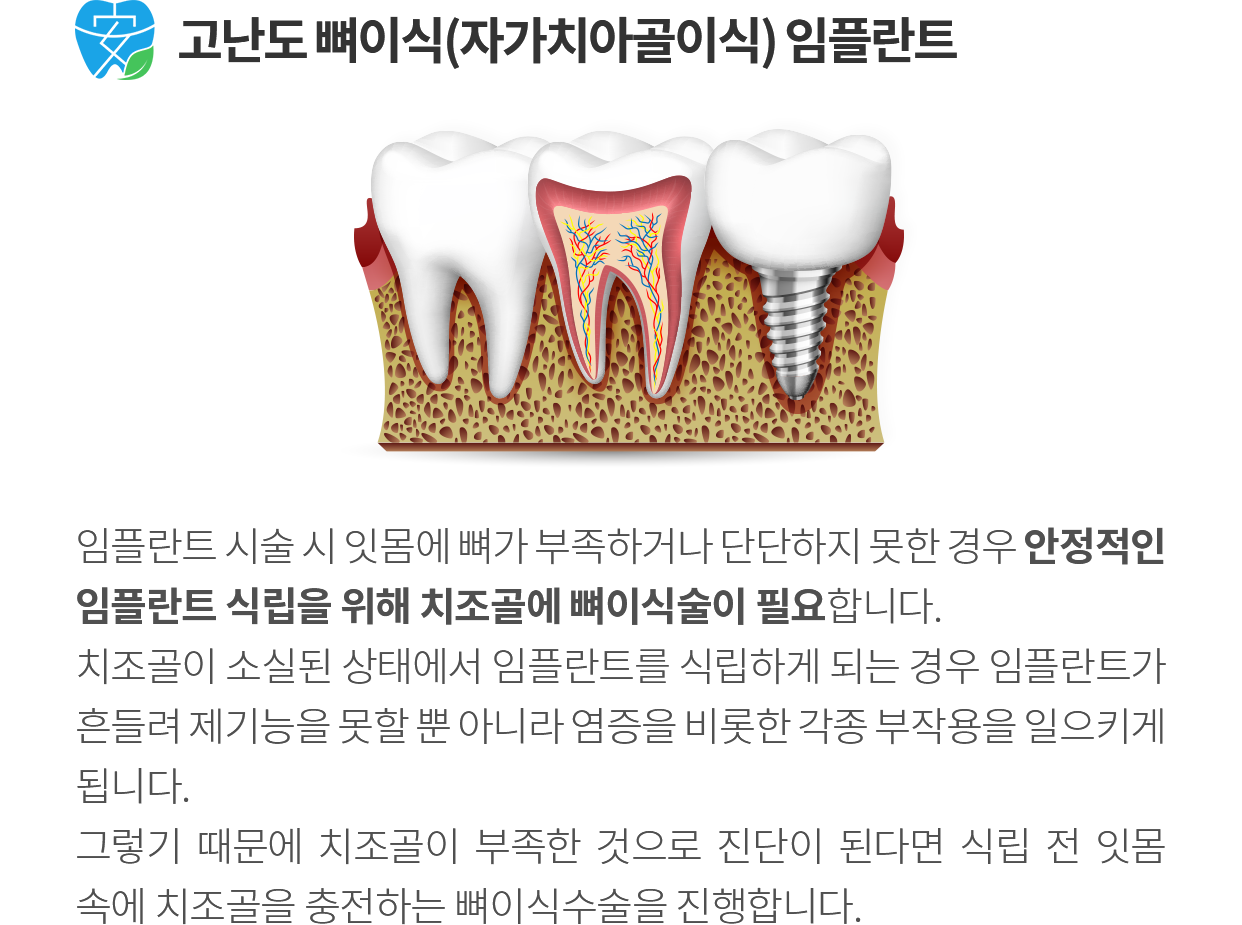 고난도 임플란트 소개