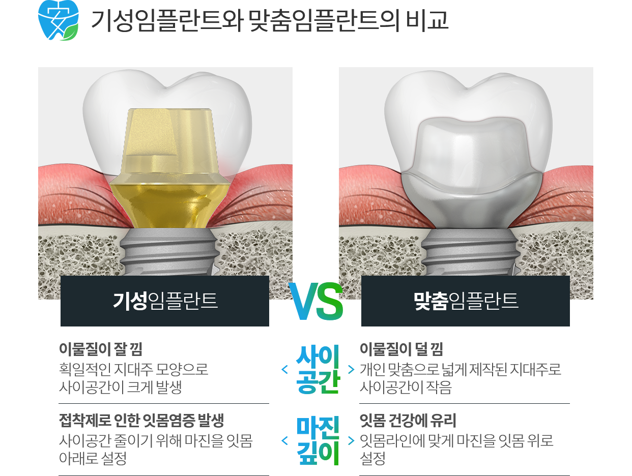 맞춤 임플란트 과정