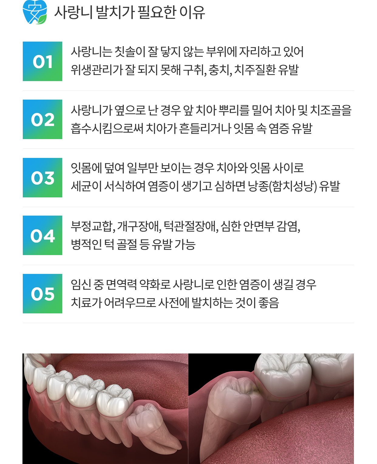 고난도 사랑니 소개