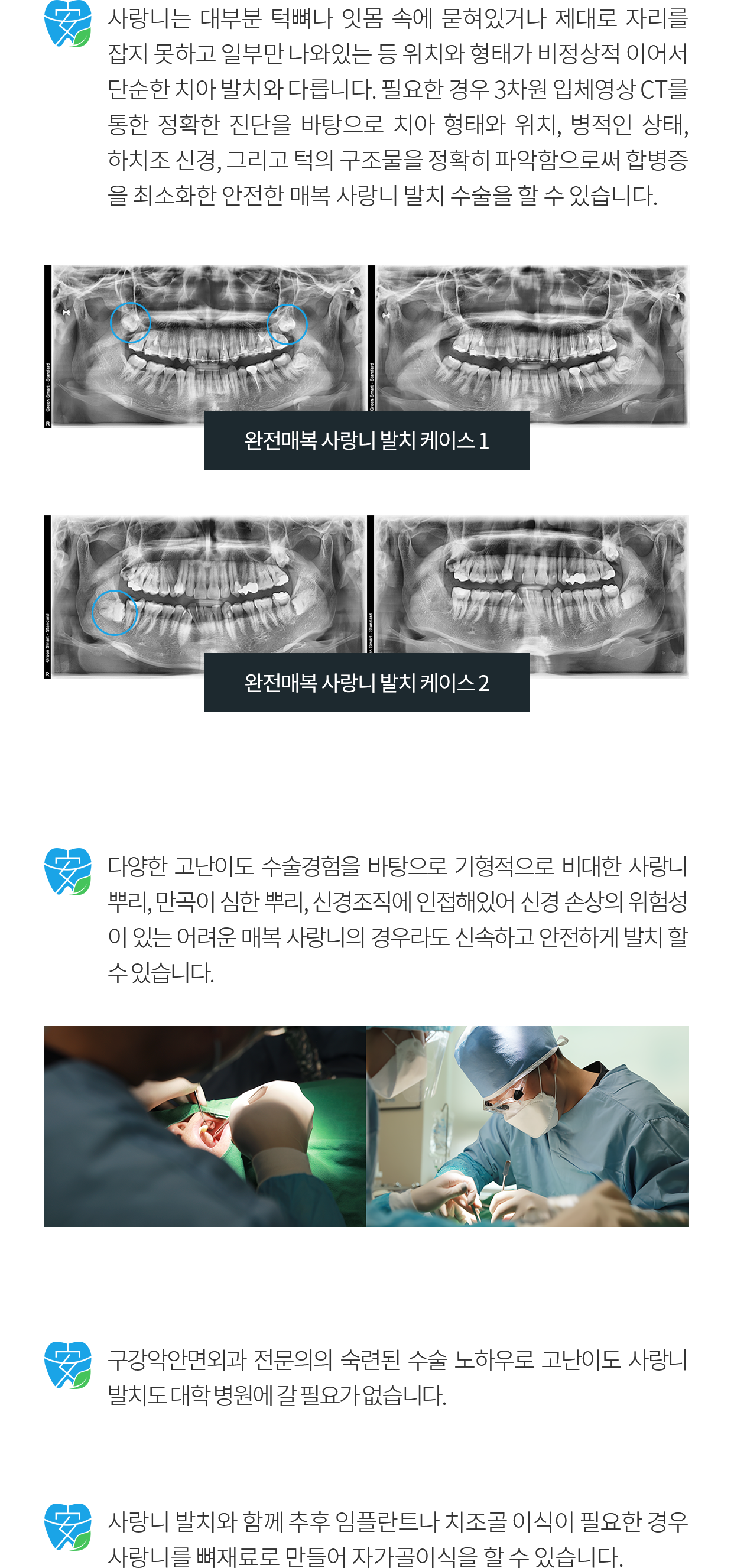 고난도 사랑니 장점