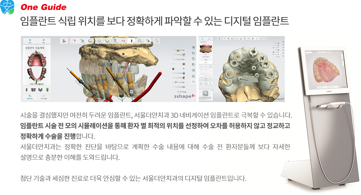 네비게이션 임플란트 장점