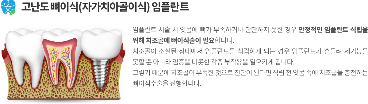 고난도 임플란트 소개