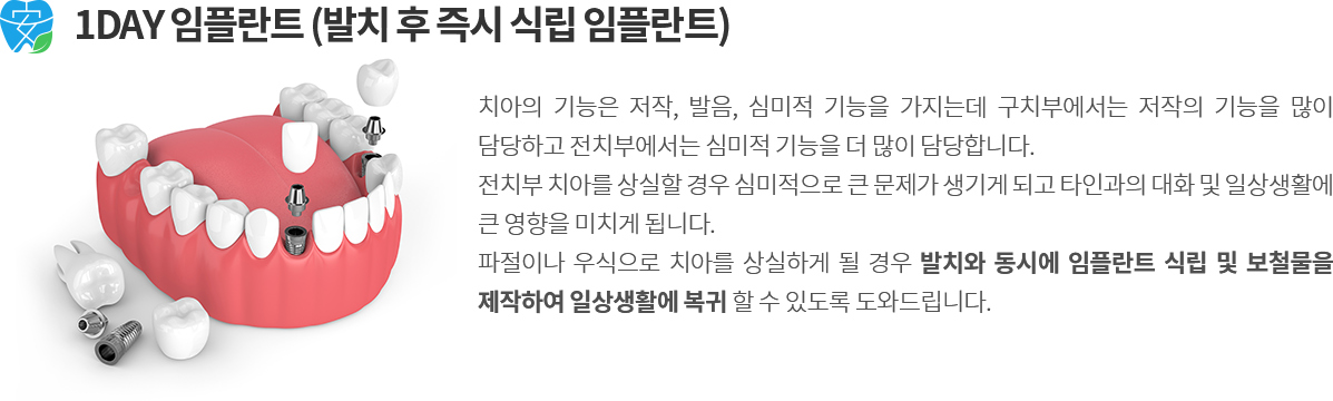 고난도 임플란트 장점