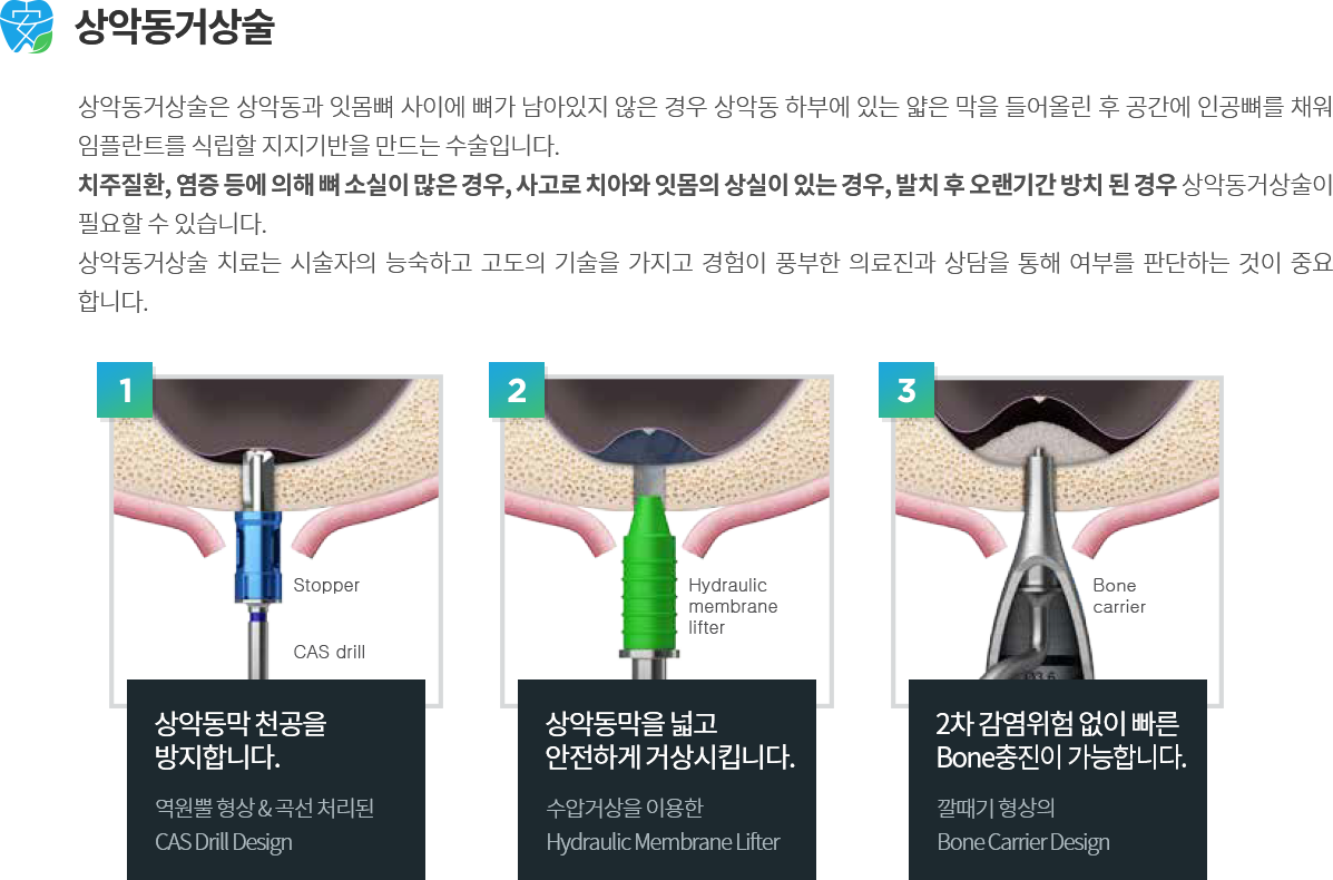 고난도 임플란트 과정