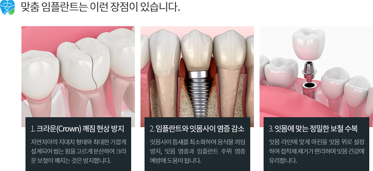 맞춤 임플란트 장점