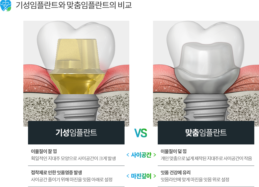 맞춤 임플란트 과정