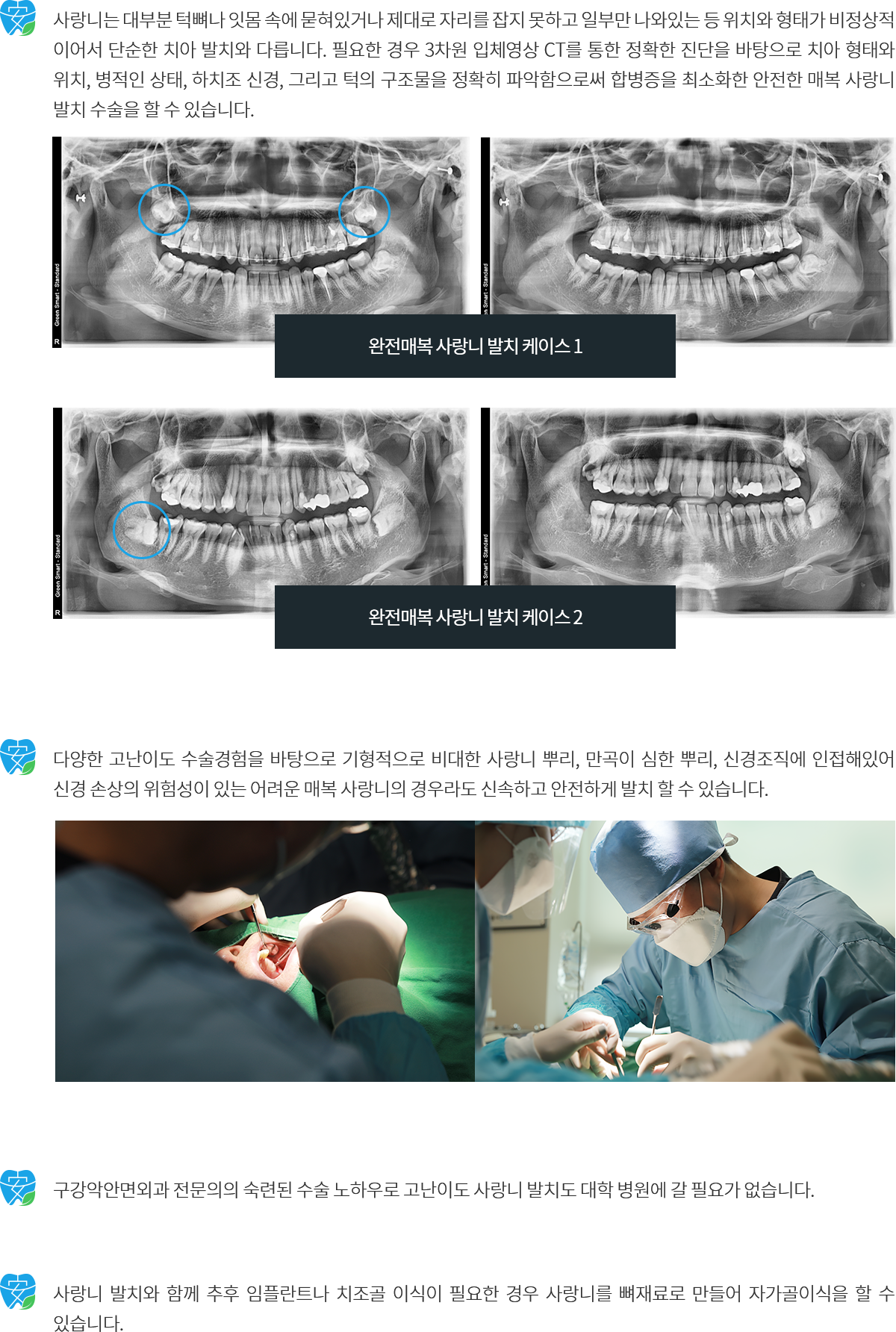 고난도 사랑니 장점